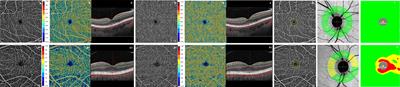 Correlation analysis between foveal avascular zone and near peripheral retinal hypoperfusion in multiple sclerosis: a wide field optical coherence tomography angiography study